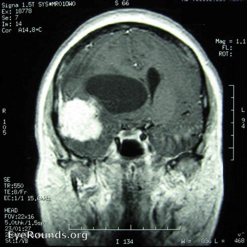 meningioma - intracranial