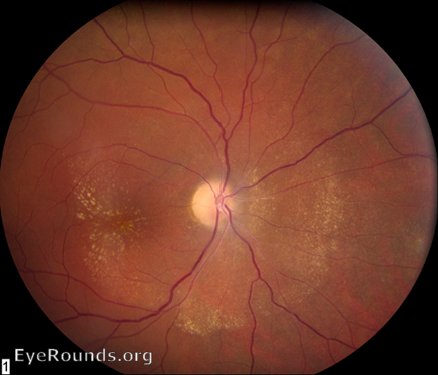 Neuroretinitis