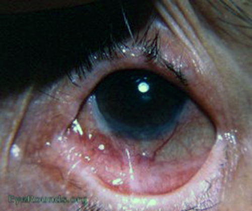 ocular pemphigoid or essential shrinkage of the conjunctiva