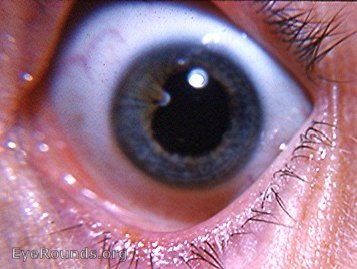 persistent pupillary membrane with anterior polar-like cataract. Very similar to the second photo in another patient.