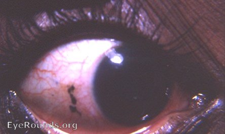 another example of a Kohl-pigmented Bitot's spot