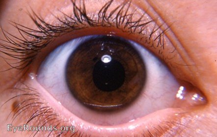 pigmented nevus of right lower lid