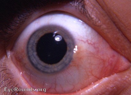 pinguecula-? starting point for a pterygium