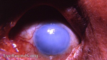 cornea: total corneal decompensation with diffuse epithelial edema following cataract surgery