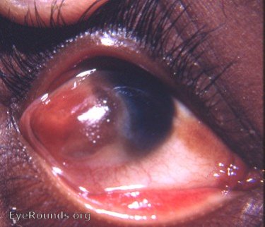 pterygium surgery - repeatedly unsuccessful surgery