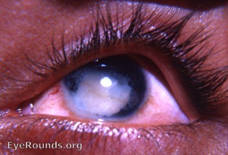 spontaneous rupture of cataracta complicata in an eye with chronic uveitis, iris atrophy, and neovascularization