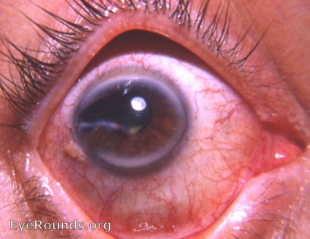 scissors perforation of cornea, adherent leukoma, arcus senilis, and prominent pinguecula