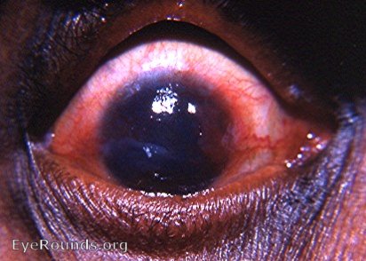 trachoma with pannus crassus