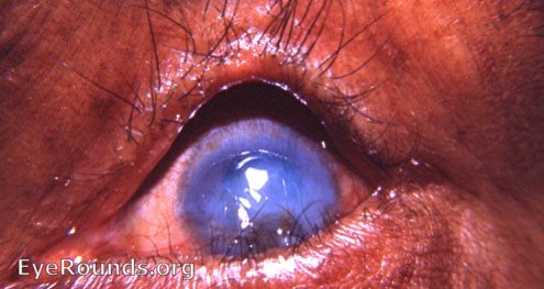 trachoma: trichiasis, pannus, and corneal scarring