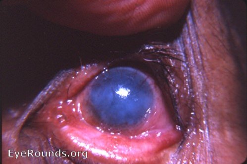 MacCallan's classification of trachoma