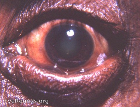 tylosis of  lower lid with slight ectropion . There is a temporal Bitot's spot.