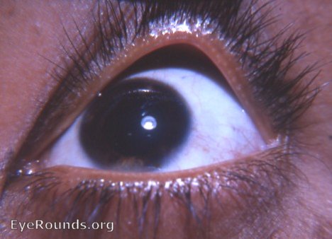 vitiligo of the iris