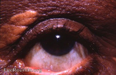 xanthelasma - left upper lid - closeup of previous Atlas photo