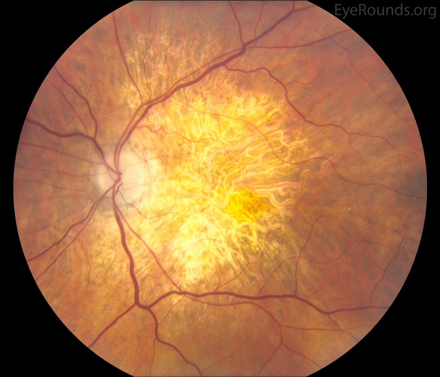Non-exudative macular degeneration with extensive geographic atrophy