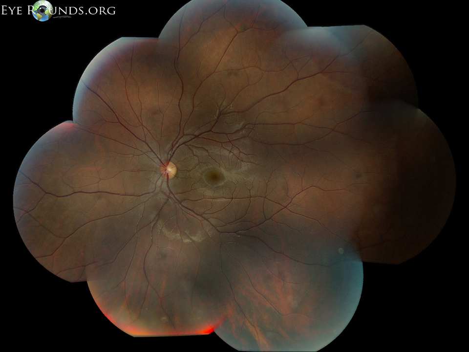 OS: clear media, normal nerve, normal vessels, normal macula; multiple faint ill-defined black spots are seen in the mid-periphery