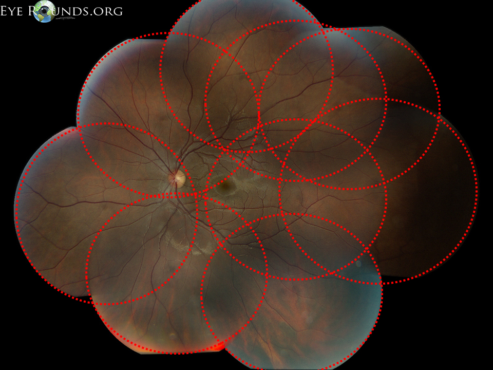 Dashed red lines show the collection of fundus photos pieced together to form the wide-field montage