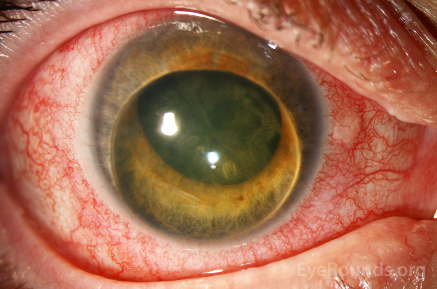 slit lamp photo of the right eye