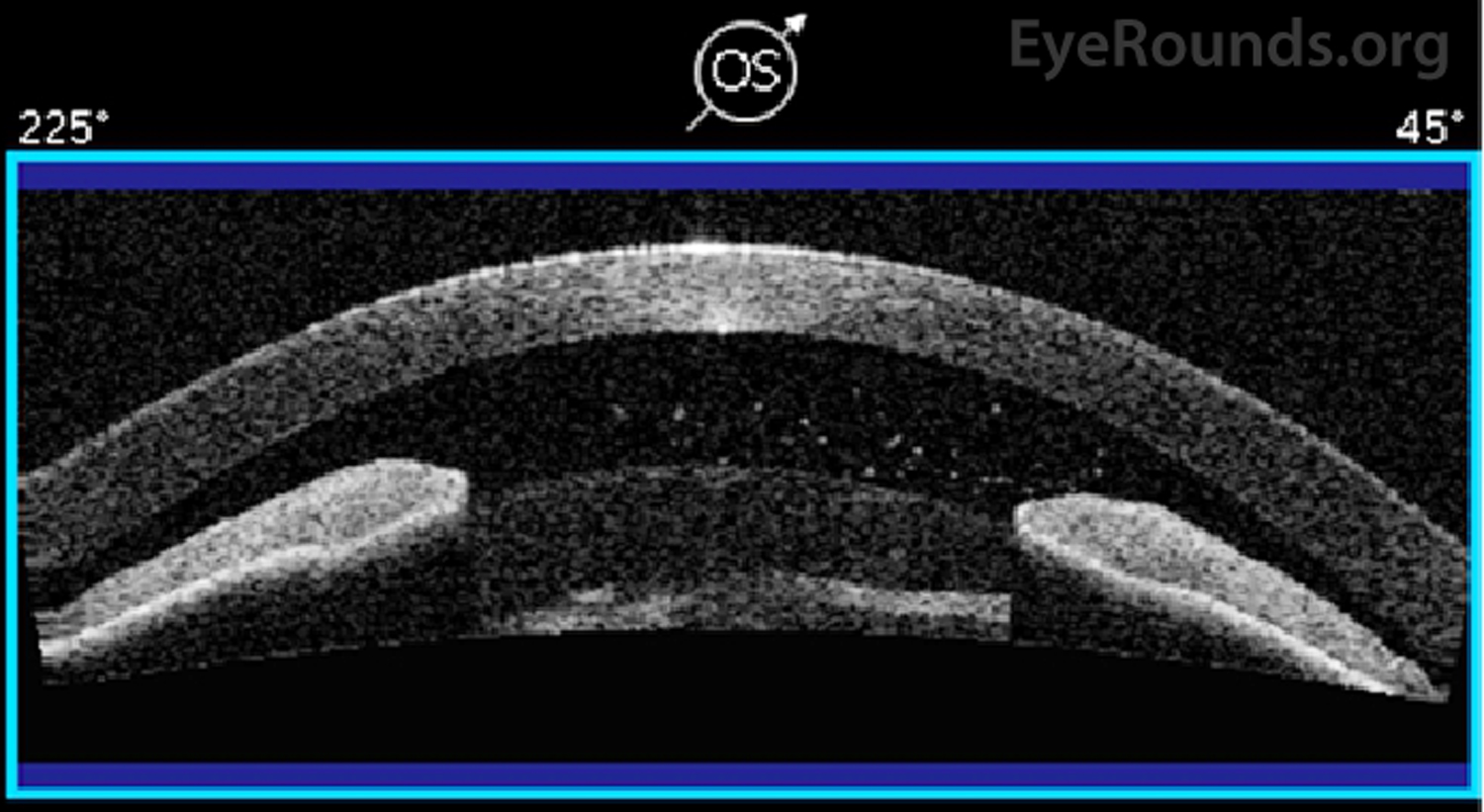 Anterior segment optical coherence tomography (AS-OCT) of the left eye