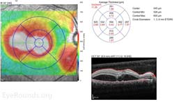 Bilateral serous retinal detachments from acute hypertensive retinopathy