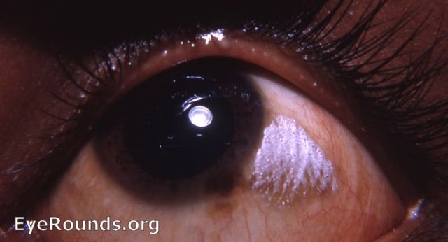 Vitamin A deficiency and its ocular manifestations