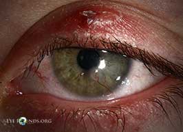 Blepharokeratoconjunctivitis of childhood