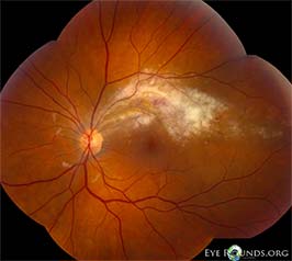Cytomegalovirus (CMV) retinitis