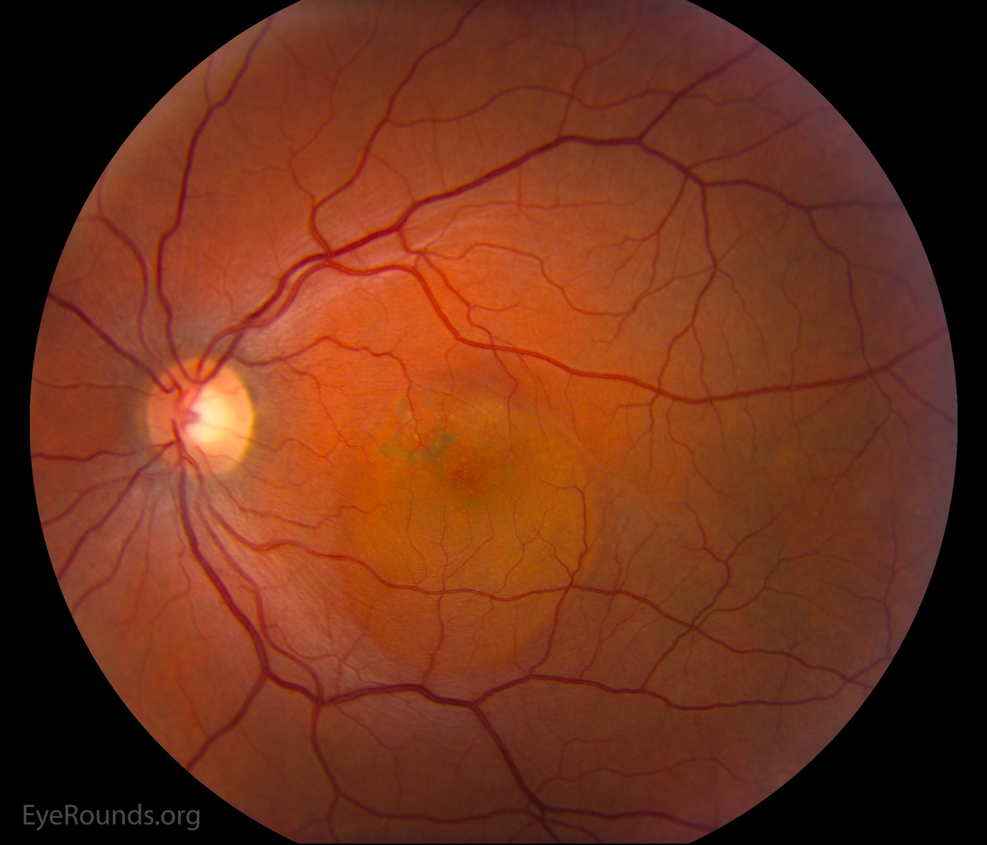 This color fundus photograph demonstrates subretinal fluid involving the fovea