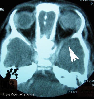 CT scan shows absence of spenoid wing