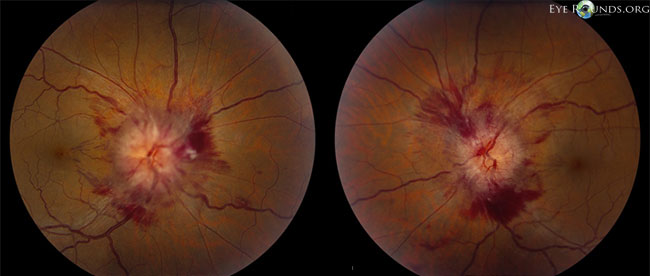 Left and Right fundus photos showing hemorrhages