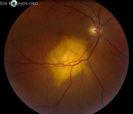 carcinoma choroidal metastasis