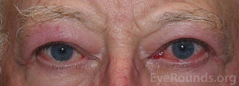 External photograph demonstrating bilateral upper and lower eyelid retraction, fullness, and erythema of periocular tissues. 
