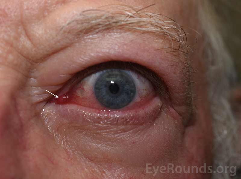 External photograph demonstrating conjunctival injection, chemosis, and caruncular edema (arrow).