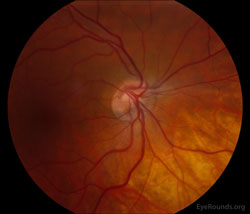Congenital tilting of the optic nerve with situs inversus