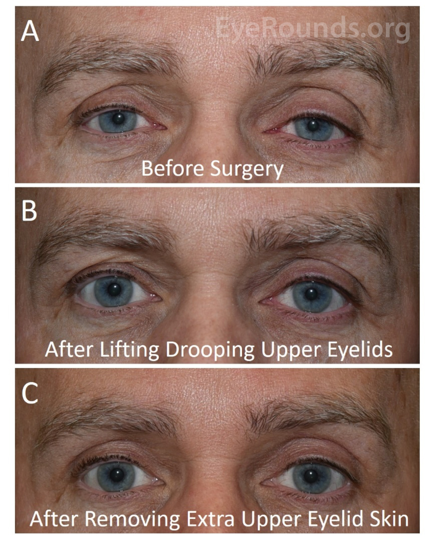 before surgery, after lift drooping upper eyelids, after removing extra upper eyelid skin