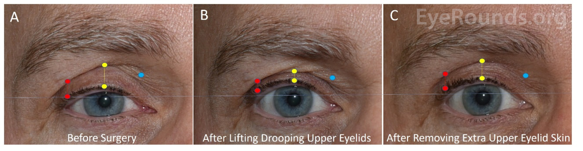 pre-surgery, post eyelid lift, and post upper eyelid blepharoplasty