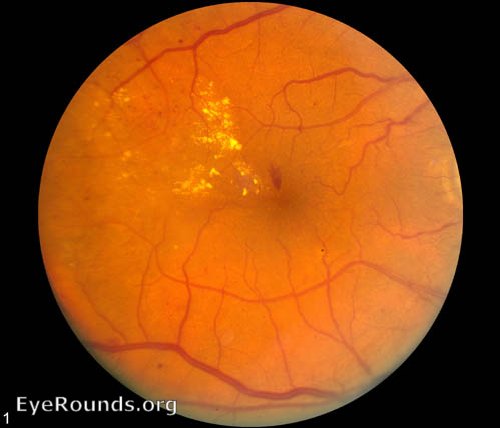 dot and blot hemorrhages diabetic retinopathy