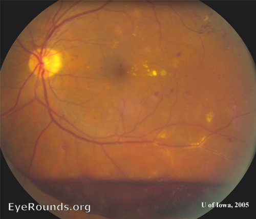 Diabetic Retinopathy  