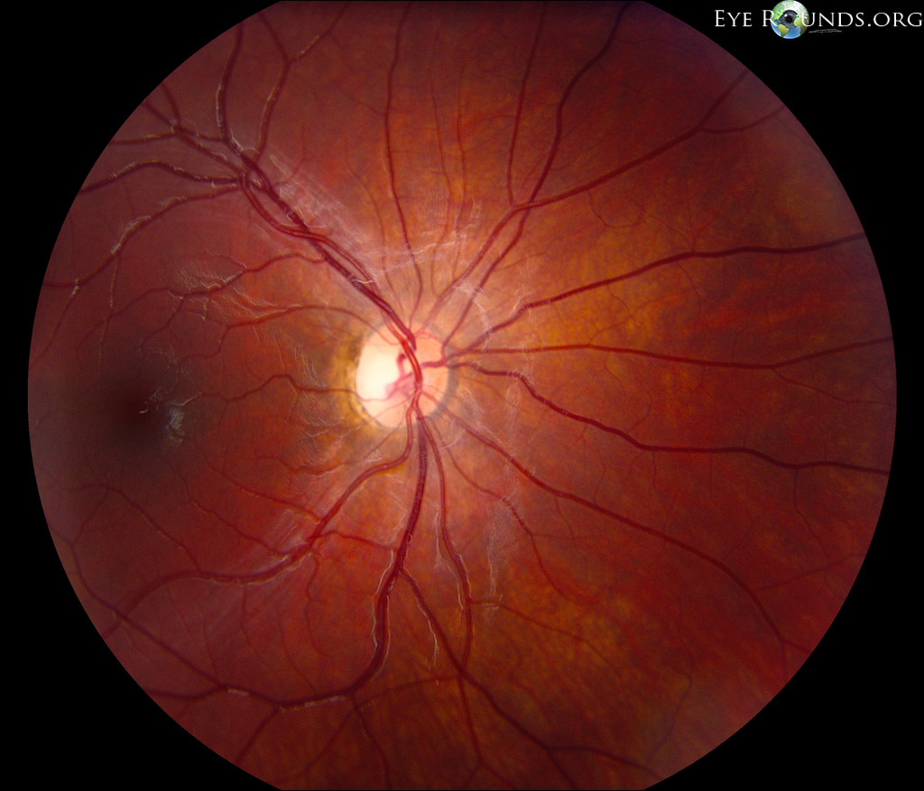 fundus of dominant optic atrophy OD