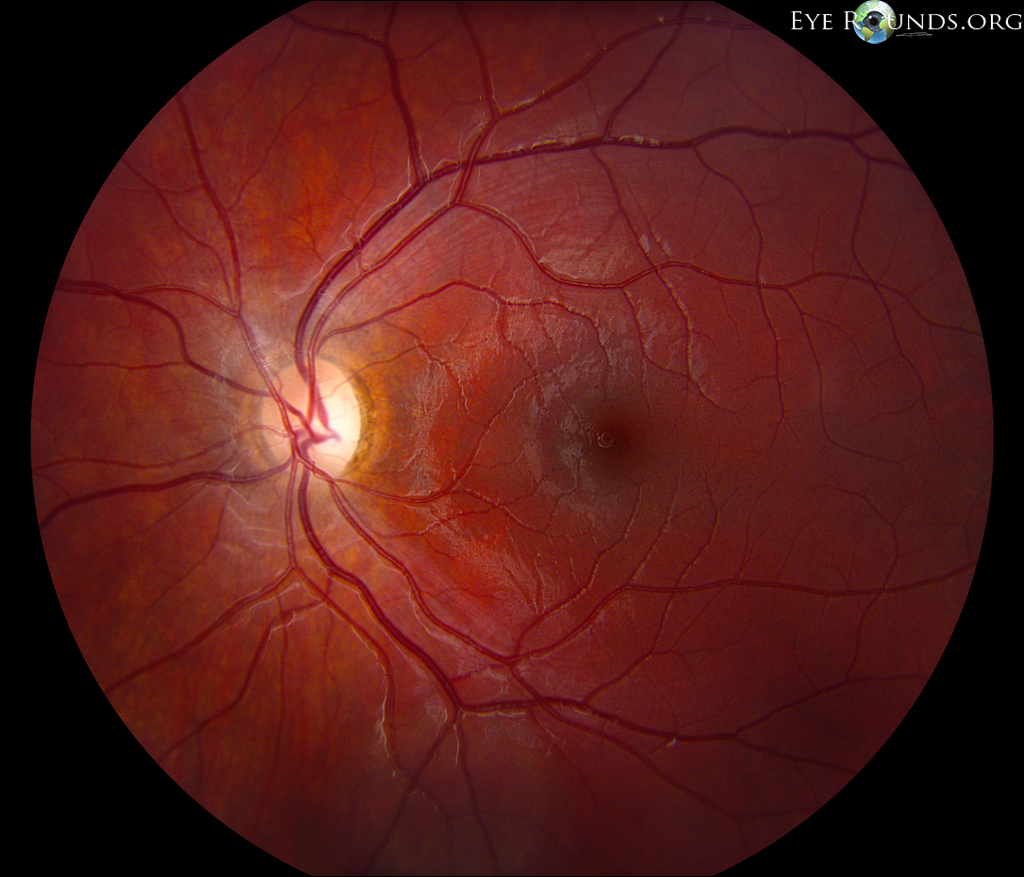fundus of dominant optic atrophy OS