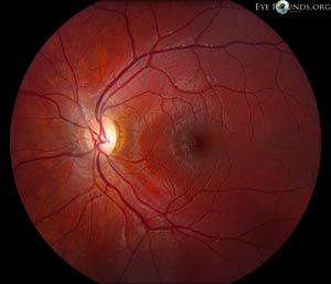 Dominant optic atrophy