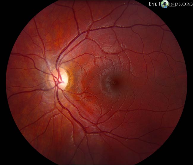 Dominant optic atrophy (Kjer syndrome)