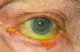 ectropion