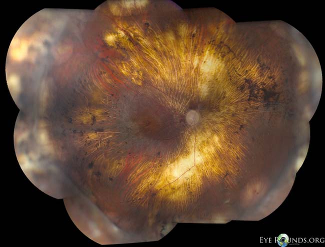 Erosive Vitreoretinopathy, right eye