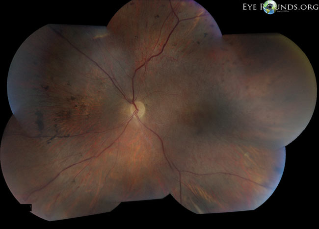 erosive vitreoretinopathy, left eye