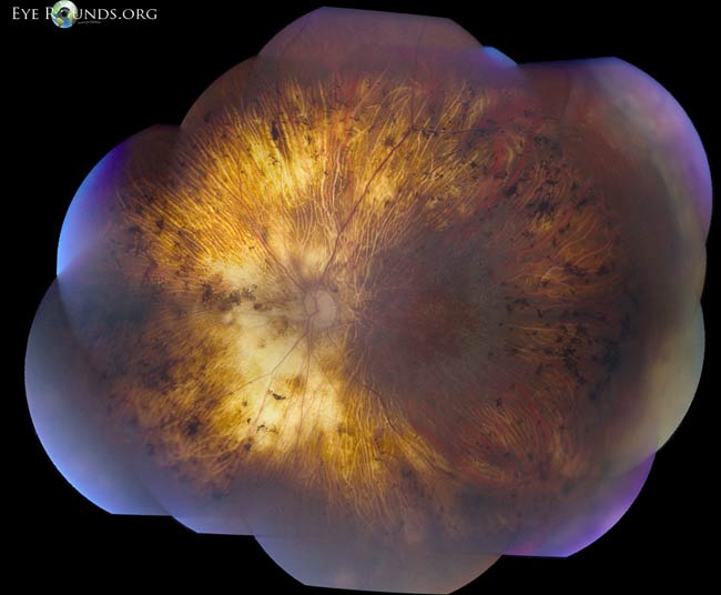 erosive vitreoretinopathy, left eye