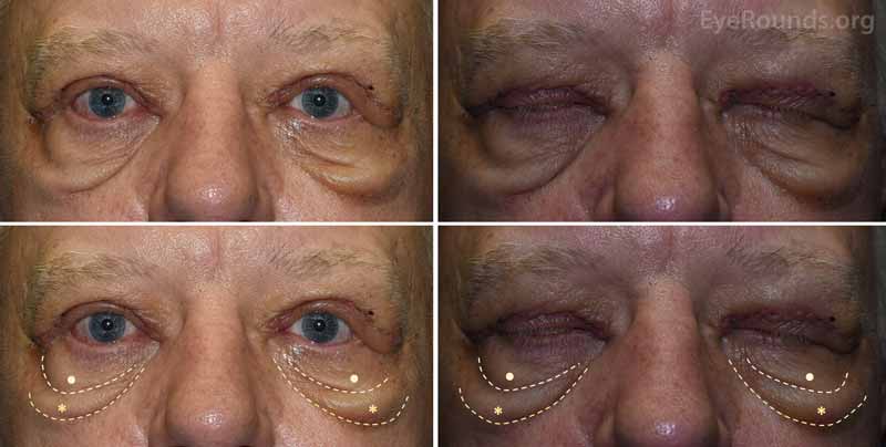 External photograph demonstrating worsening of the bilateral malar mounds from the patient in Figure 1.  The patient underwent bilateral upper eyelid surgery.  At post-operative week 1, the edema traveled along the inferior face, resulting in increased size and prominence of the festoons.