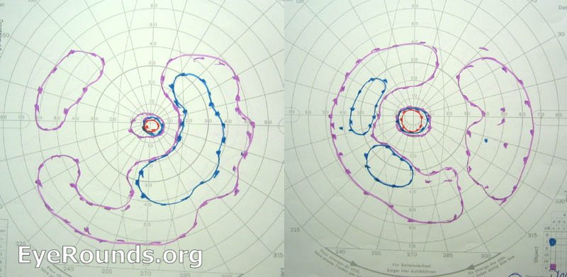 Goldmann visual perimetry  demonstrating bilateral ring-pattern scotomas