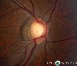 Gray crescent of the optic nerve head