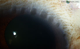 Herbert's pits (trachoma)