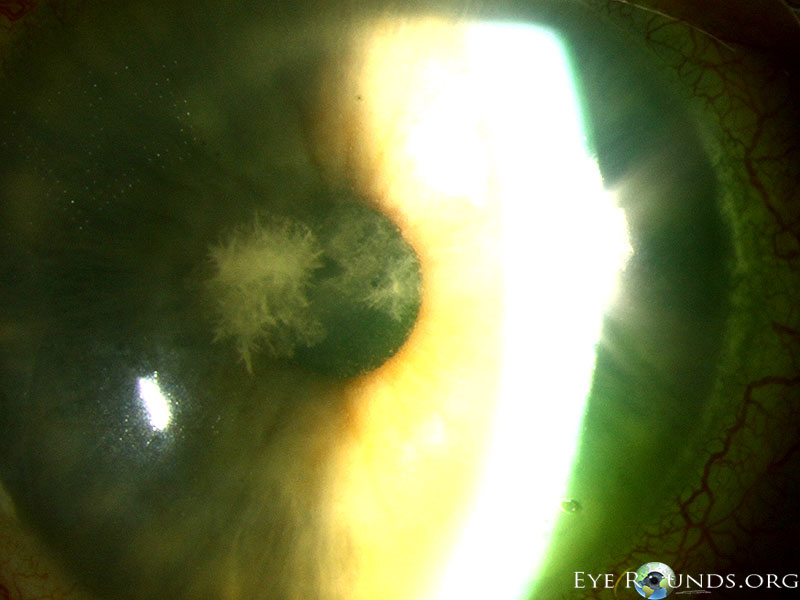 indolent corneal infection classically occuring in the absence of an epithelial defect in corneal transplants on chronic steroid therapy
